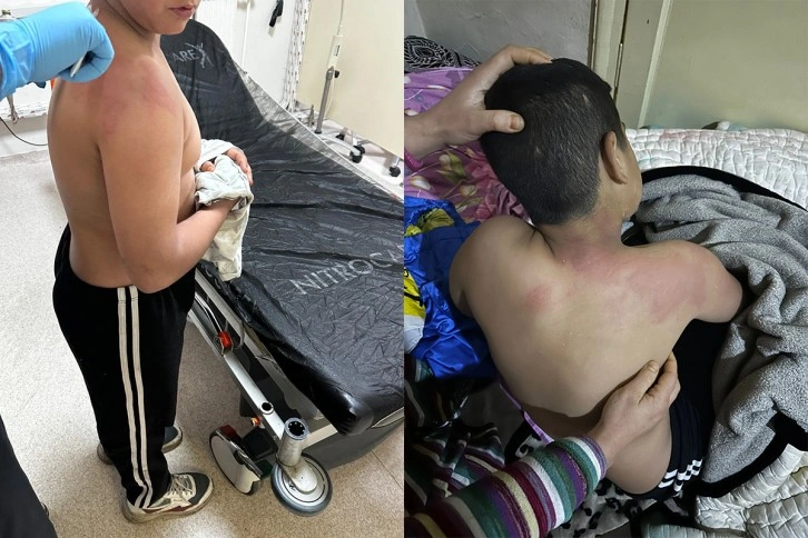 Seçim bürosunda çirkin olay... CHP seçim bürosunda 10 yaşındaki çocuğa kaynar çay fırlatıldı