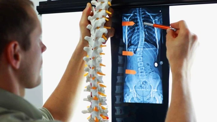 Skolyoz nedir,  tedavisi var mı? Skolyoz hastalarının görüntüsü...