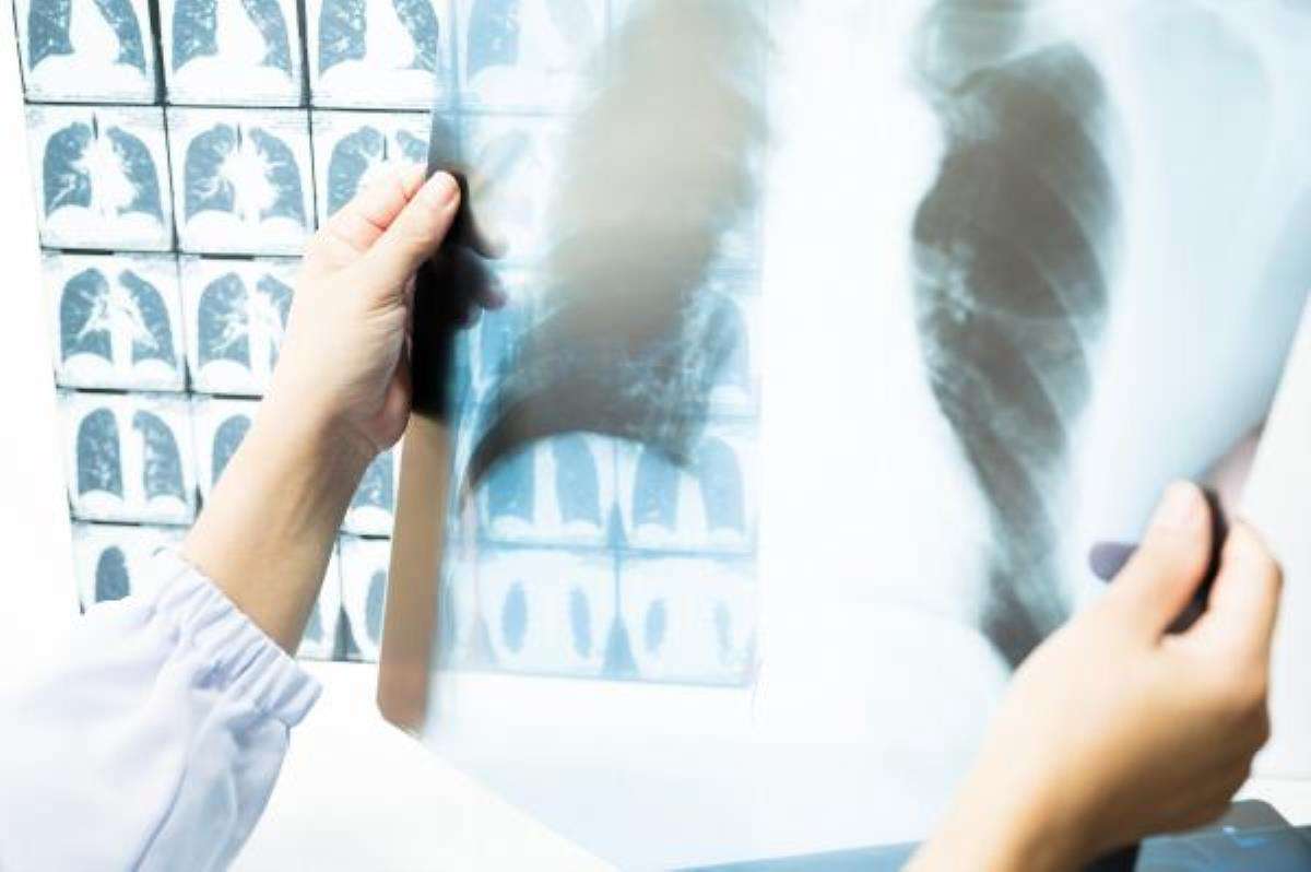 Amerikan Kanser Derneği açıkladı; akciğer kanserinde tarama yaşı düştü