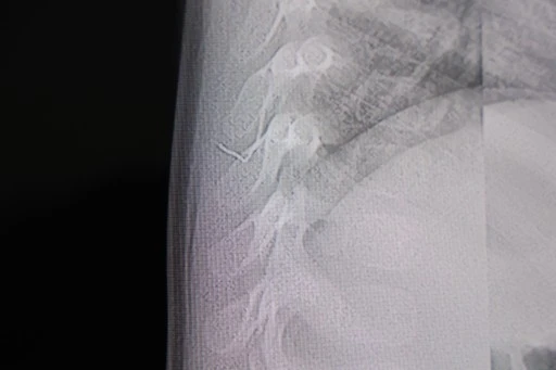 Bebeğin sırtından tel par&ccedil;ası &ccedil;ıktı