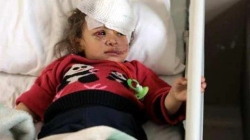 Eşeğin ısırdığı küçük Fatma'ya, boynundan alınan doku ile yeni göz kapağı yapıldı