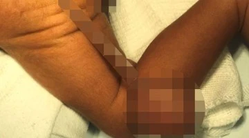 40’ncı vaka: Brezilya’da bir bebek, 12 cm kuyrukla doğdu