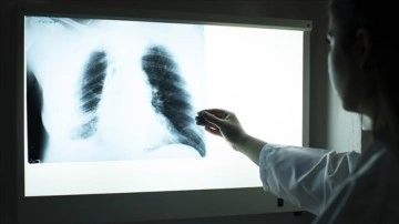 "Kovid-19, tüberkülozun tanı ve tedavisini olumsuz etkiliyor" uyarısı