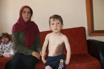 Küçük Samet vücudunu saran dev benlerin tedavi edilmesini istiyor